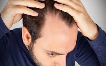 ایا ریزش مو ربطی به دیابت دارد؟