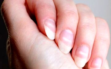 چه بیماری هایی از ظاهر ناخن‌ها مشخص است؟

