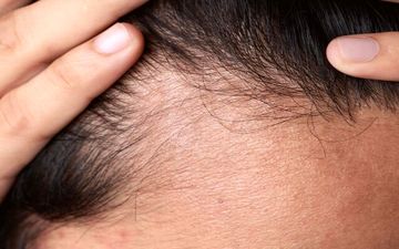 4 تکنیک ساده برای جلوگیری از ریزش مو