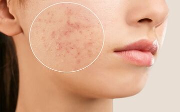 رمزگشایی از دلایل آکنه در قسمت‌های مختلف صورت