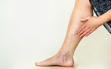 علائم واریس پا در زنان چیست؟

