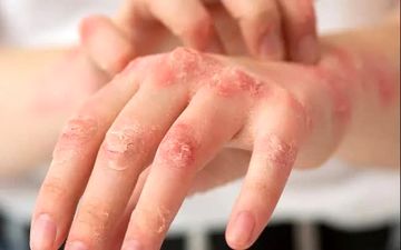 چگونه با تغییرات کوچک، از شر اگزمای دست خلاص شویم؟