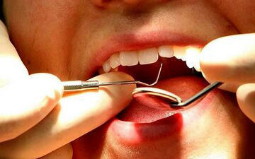 از نشانه های عفونت لثه آگاهی دارید؟