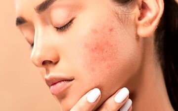 آیا جوش‌ صورت واگیردار است؟