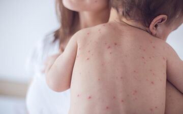 در صورت ابتلا به آبله مرغان چند روز در قرنطینه باشیم؟