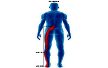 سیاتیک اذیتت میکنه؟ بیا تا درمان سه سوته را نشونت بدم!