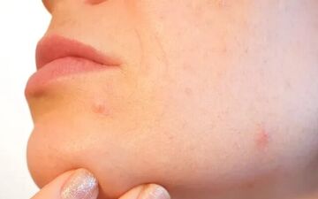 راهی برای خلاصی از شر آکنه‌ها