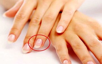  علت لکه های سفید روی ناخن ها چیست؟