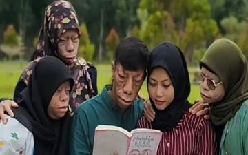 سندروم عجیبی که «خانواده مارمولکی» را اسیر کرد!