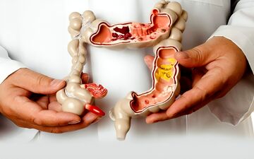 برای سندرم روده تحریک پذیر  دارو موثر است یا رژیم غذایی؟