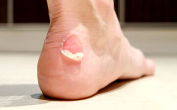 چطور از تاول، ترک پاشنه و پینه پا پیشگیری کنیم؟