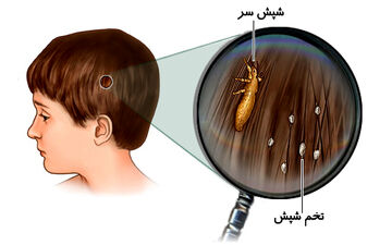 آیا زمستان باعث ابتلا به شپش در مدارس شده است؟! +نکات مهم 