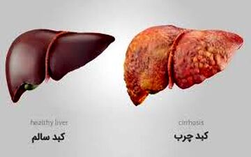 پشت پرده ارتباط مرگبار دیابت و کبد چرب/ دارویی که هر دو را مهار می‌کند!
