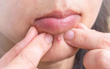 برای اینکه جوش نزنیم چه بخوریم؟