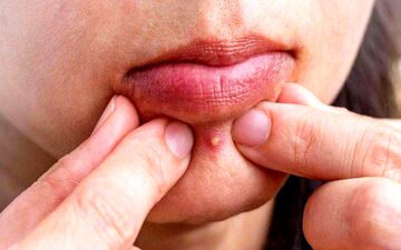برای اینکه جوش نزنیم چه بخوریم؟