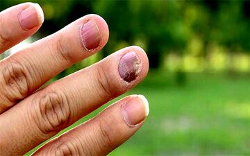 احتمال بروز قارچ در ناخن های کاشت شده