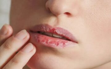 علت ترک در اطراف دهان و لب‌های پوسته پوسته چیست؟