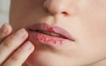 علت ترک در اطراف دهان و لب‌های پوسته پوسته چیست؟