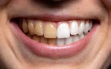 جرم‌گیری دندان چیست و چرا اهمیت دارد؟