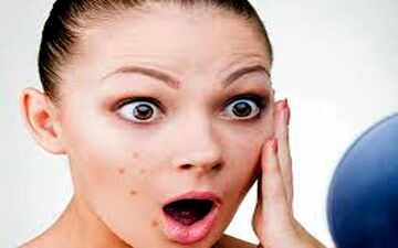 واکسن آکنه در راه بازار است!/ رهایی از شر جوش‌ها با کمک واکسن آکنه