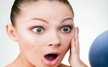 واکسن آکنه در راه بازار است!/ رهایی از شر جوش‌ها با کمک واکسن آکنه