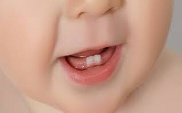دندان شیری کودکان را دور نیندازید
