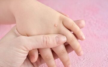 از علت تا درمان زگیل‌های دوران کودکی