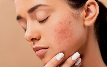 خودارضایی باعث آکنه می شود؟