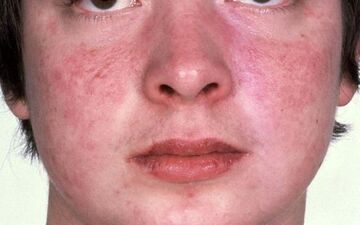 آلرژی به سیر چه علائمی دارد؟