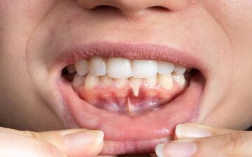 سلامت لثه به چه عواملی بستگی داره؟