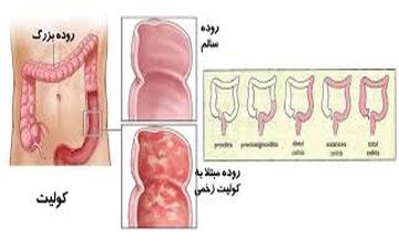 همه چیز درباره کولیت روده 