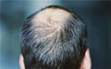 کاهش سن ریزش مو/ دلایلی که سبب کچلی می‌شود
