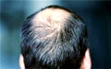 کاهش سن ریزش مو/ دلایلی که سبب کچلی می‌شود