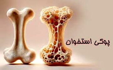 علائم اولیه پوکی استخوان‌