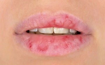 خشکی دهان و زبان؛ چه زمانی زنگ خطر بیماری به صدا درمی‌آید؟