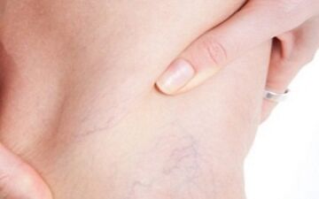 5 راهکار طلایی برای درمان دردهای واریس