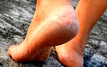 ترک پاشنه پا به کمبود ویتامین خاصی مرتبط است؟