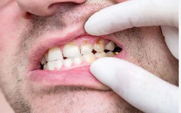 کمبود ویتامین A سبب پوسیدگی دندان میشود؟