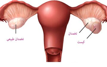 کیست تخمدان چه علائمی دارد؛ به چه روش هایی درمان می شود و راه های پیشگیری از آن چیست؟