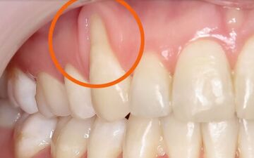 چرا لثه‌هایتان عقب رفته؟ | چگونه از عقب‌رفتگی لثه پیشگیری کنیم؟