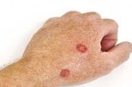 چگونه از سرطان پوست پیشگیری کنیم؟