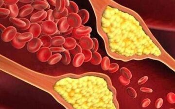 علامت مهم ابتلا به کلسترول خون کدام است؟