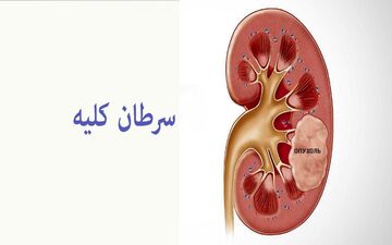 سرطان کلیه: از علائم هشداردهنده تا روش‌های نوین درمان