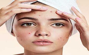 اگر زیاد جوش میزنید این نوشیدنی را مصرف کنید
