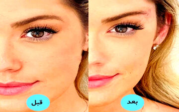جوان‌تر شدن و زیباتر شدن چشم و ابرو با جراحی لیفت شقیقه
