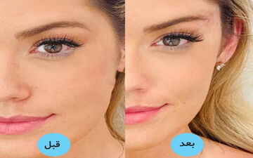 جوان‌تر شدن و زیباتر شدن چشم و ابرو با جراحی لیفت شقیقه