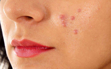 جوش‌های زیر پوستی |چگونه جوش‌های زیر پوستی را از بین ببریم؟