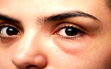 آیا پف زیر چشم خطرناک است؟