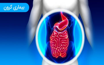  عوامل موثر در ابتلا به کرون