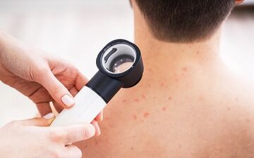 خال های قرمز خطرناک هستند؟